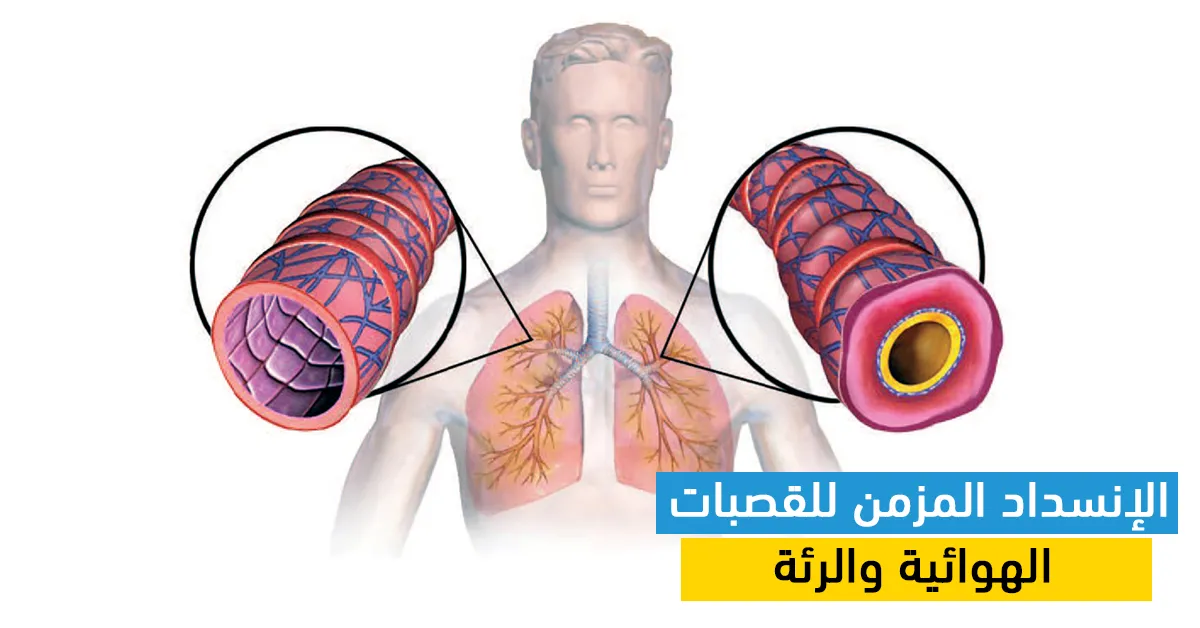 الإنسداد المزمن للقصبات الهوائية والرئة